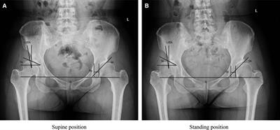 A New Parameter of Hip Instability in Developmental Dysplasia of the Hip (DDH): Teardrop Distance